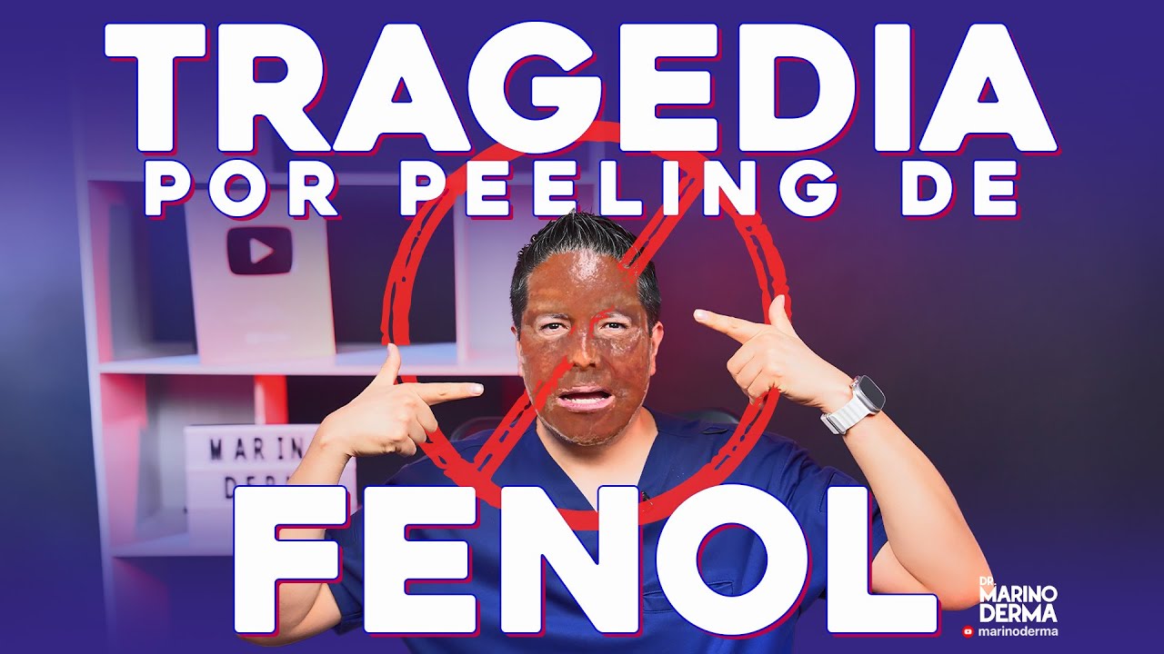 TRAGEDIA POR PEELING DE FENOL