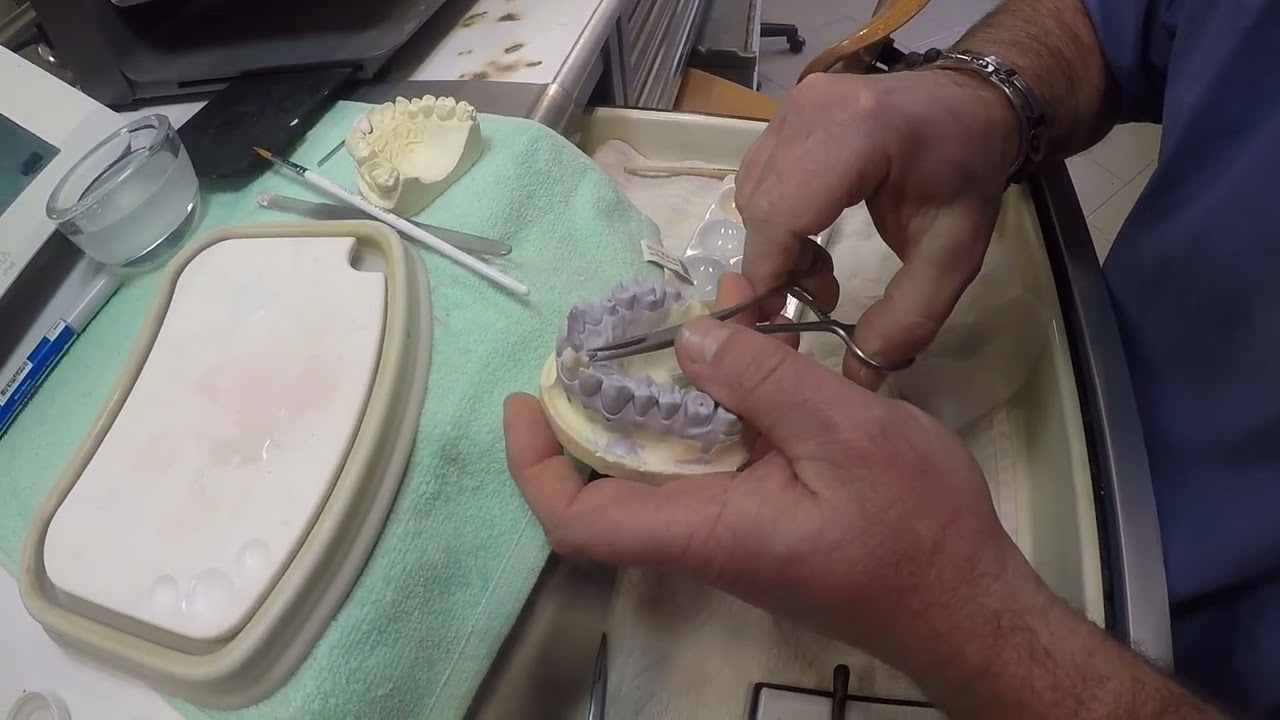 ceramica su sottostruttura metallica (didattico)