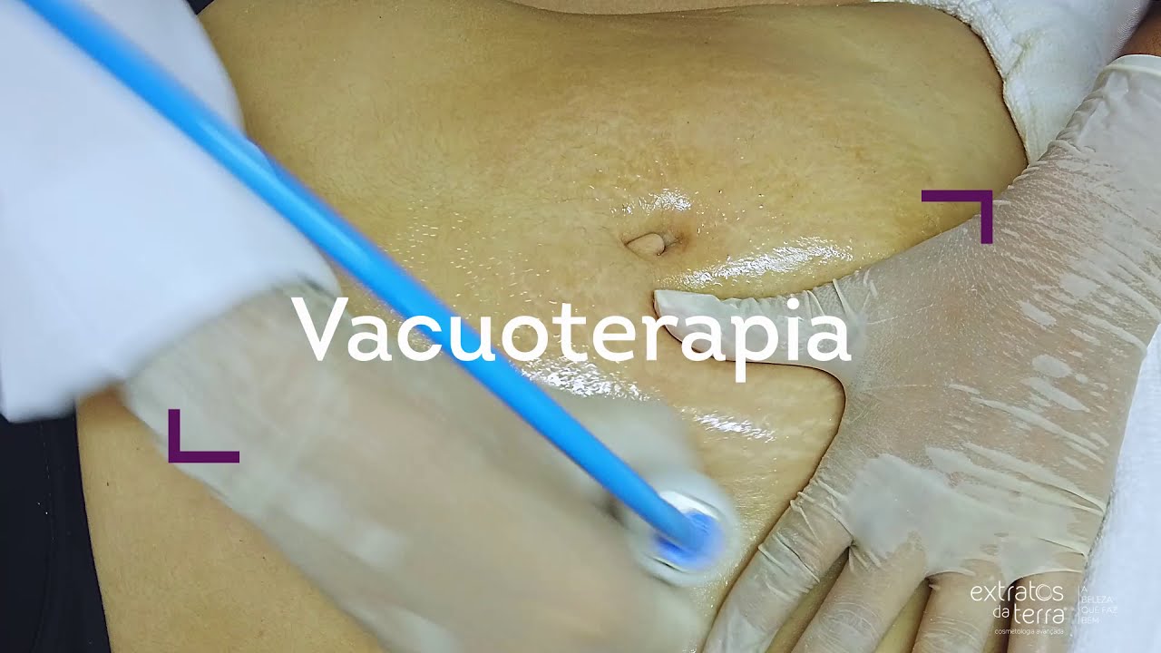Estrias - Protocolo de tratamento com Microdermoabrasão e vacuoterapia