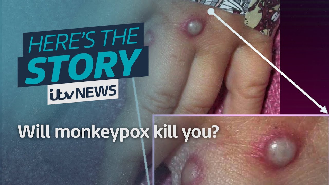 Will monkeypox kill you? | ITV News