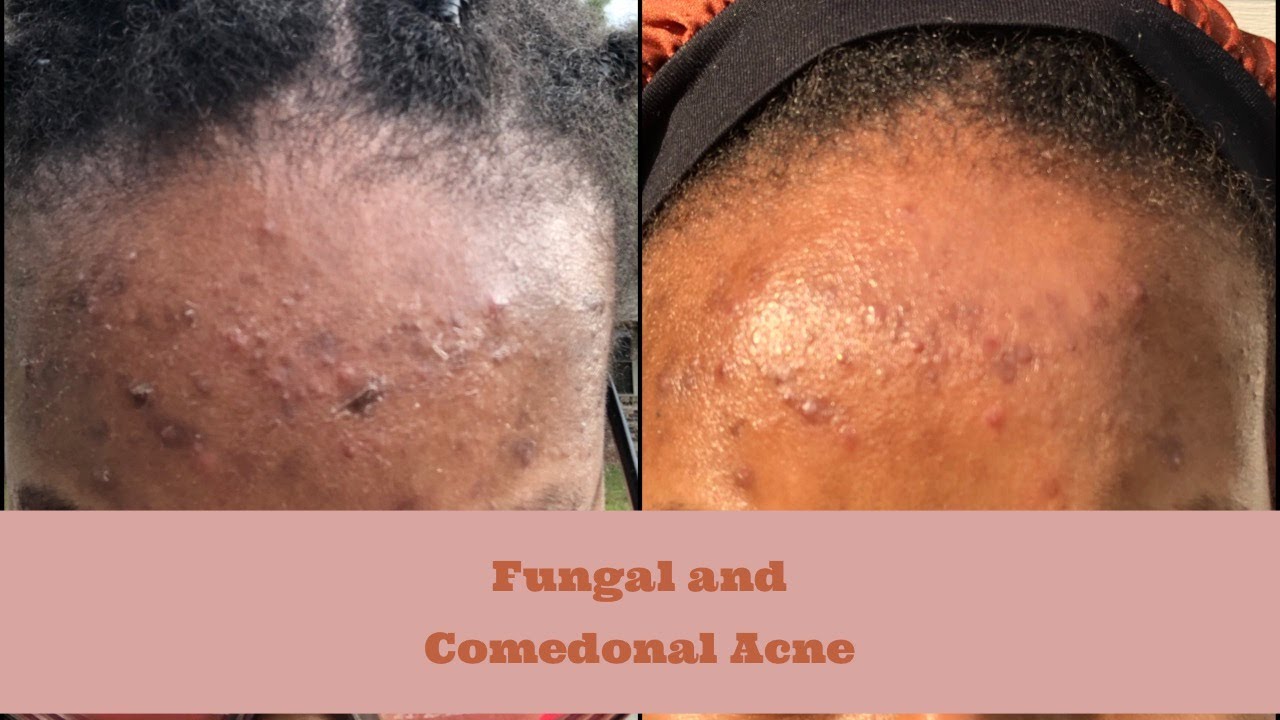 Clearing up my Fungal and Comedonal Forehead Acne?? | Skin Diary + Routine | Malassezia Folliculitis