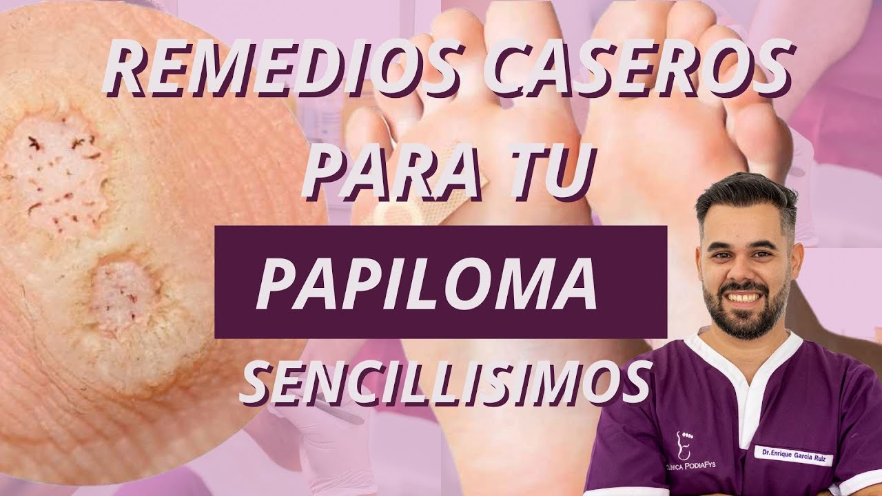 5 REMEDIOS CASEROS PARA CURAR UN PAPILOMA