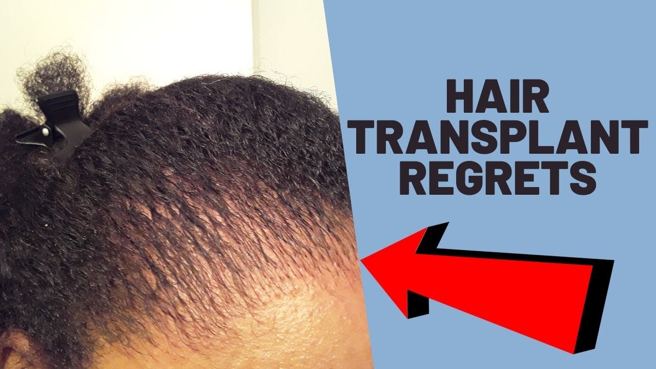 I Hate My Hair Transplant!!!! Natural Transplants Hair Restoration Clinic
