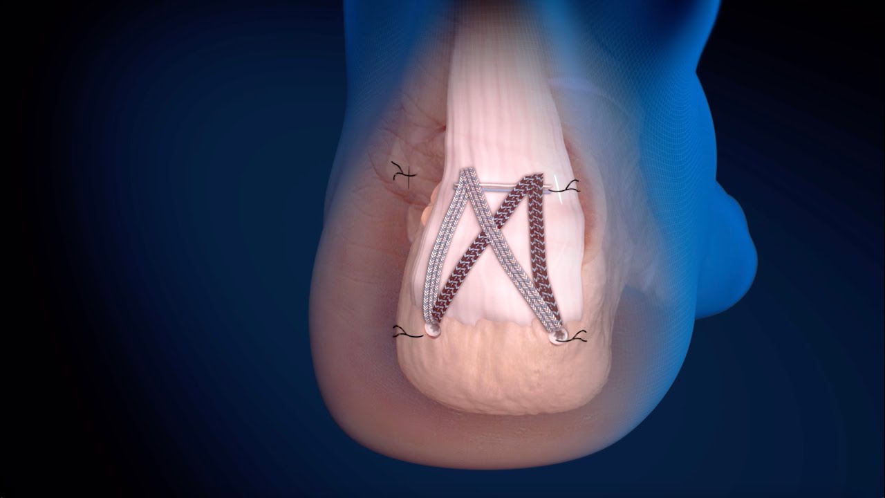 The Evolution of Insertional Achilles Repair - Anthony Mechrefe, MD