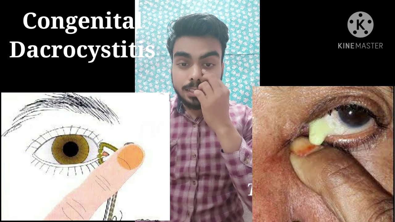 Congenital Dacrocystitis : Inflammation in Lacrimal sac since birth.