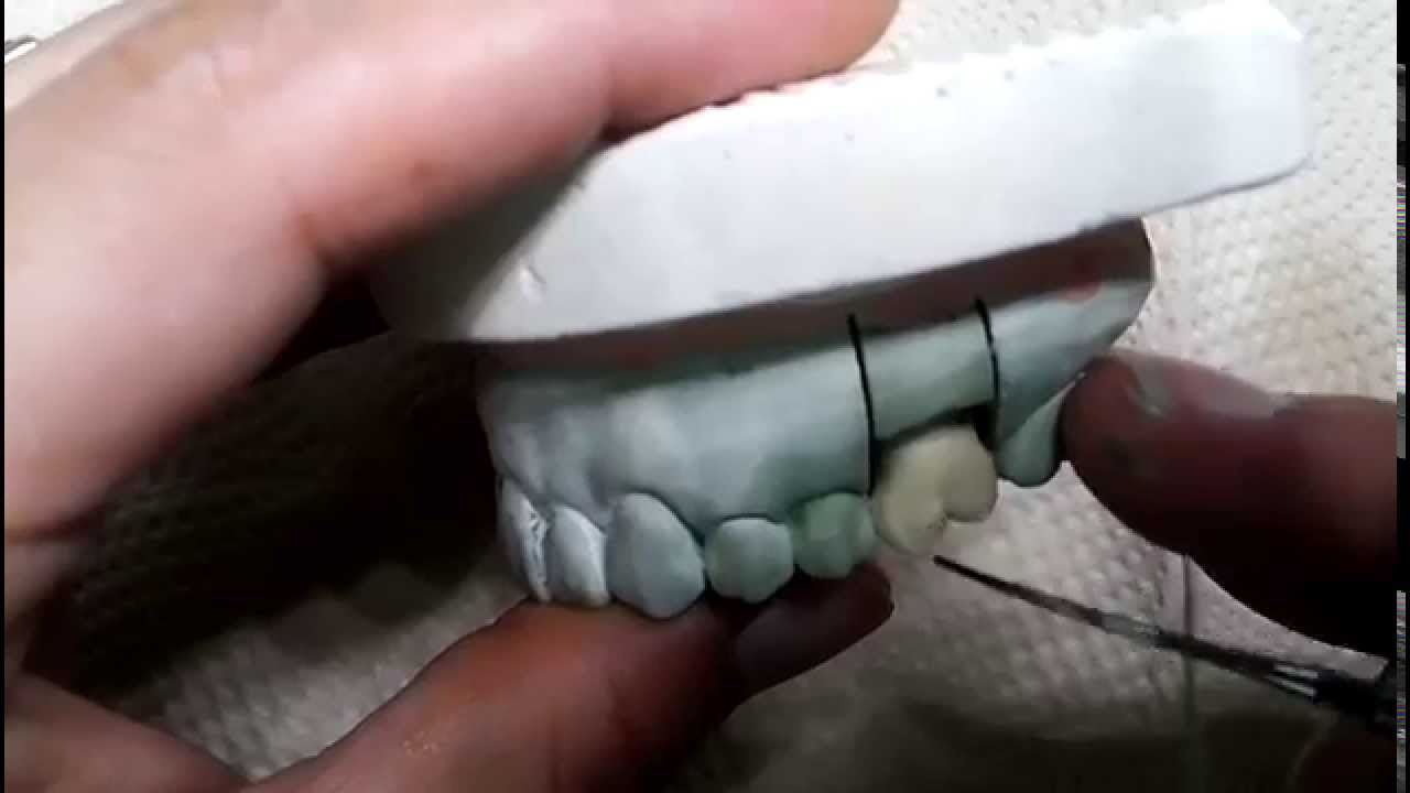 Dental wax up