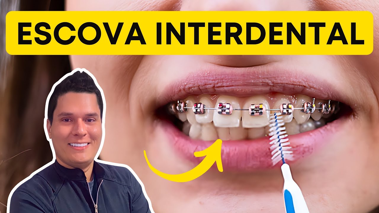 ESCOVA INTERDENTAL : COMO USAR DO JEITO CERTO? (GUIA PRÁTICO).
