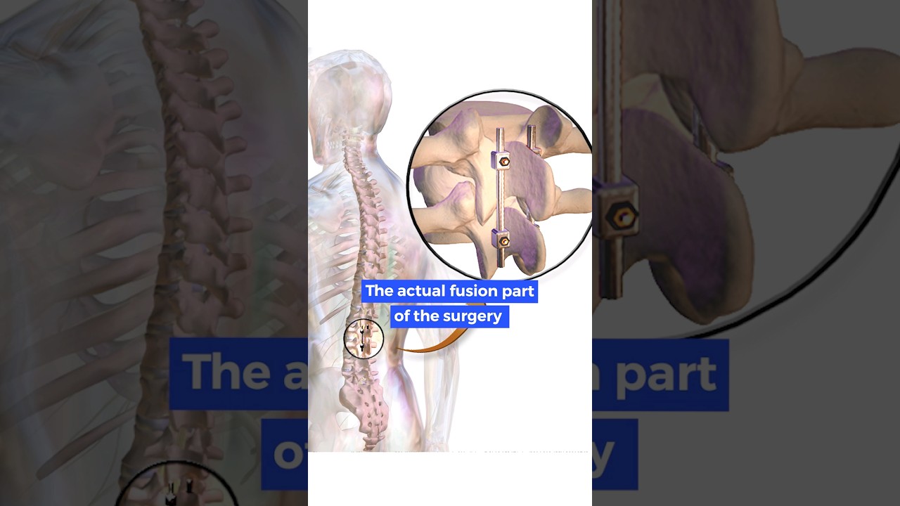 What happens in Spinal fusion surgery?
