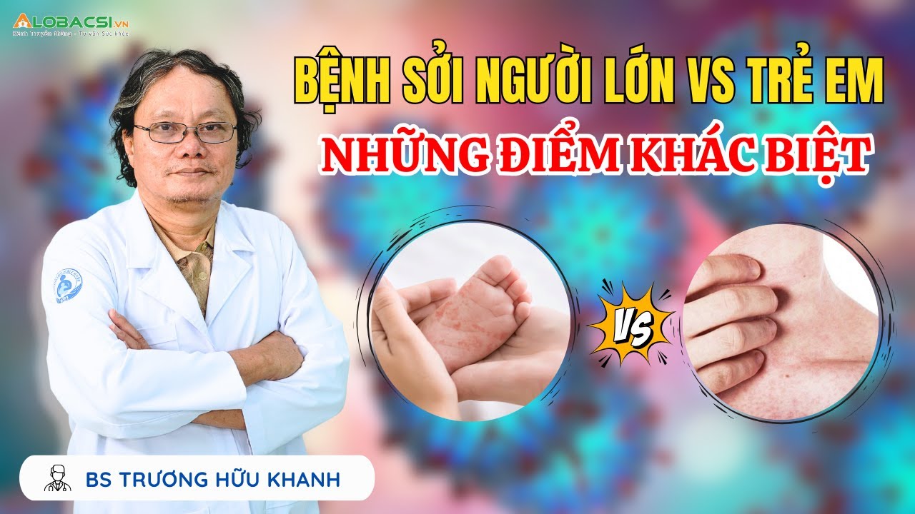 Bệnh sởi NGƯỜI LỚN VS TRẺ EM Những điểm khác biệt? | Trương Hữu Khanh