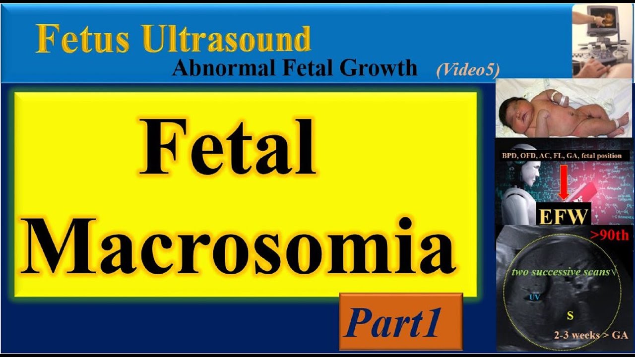 Fetus Ultrasound, Fetal Macrosomia- Part1
