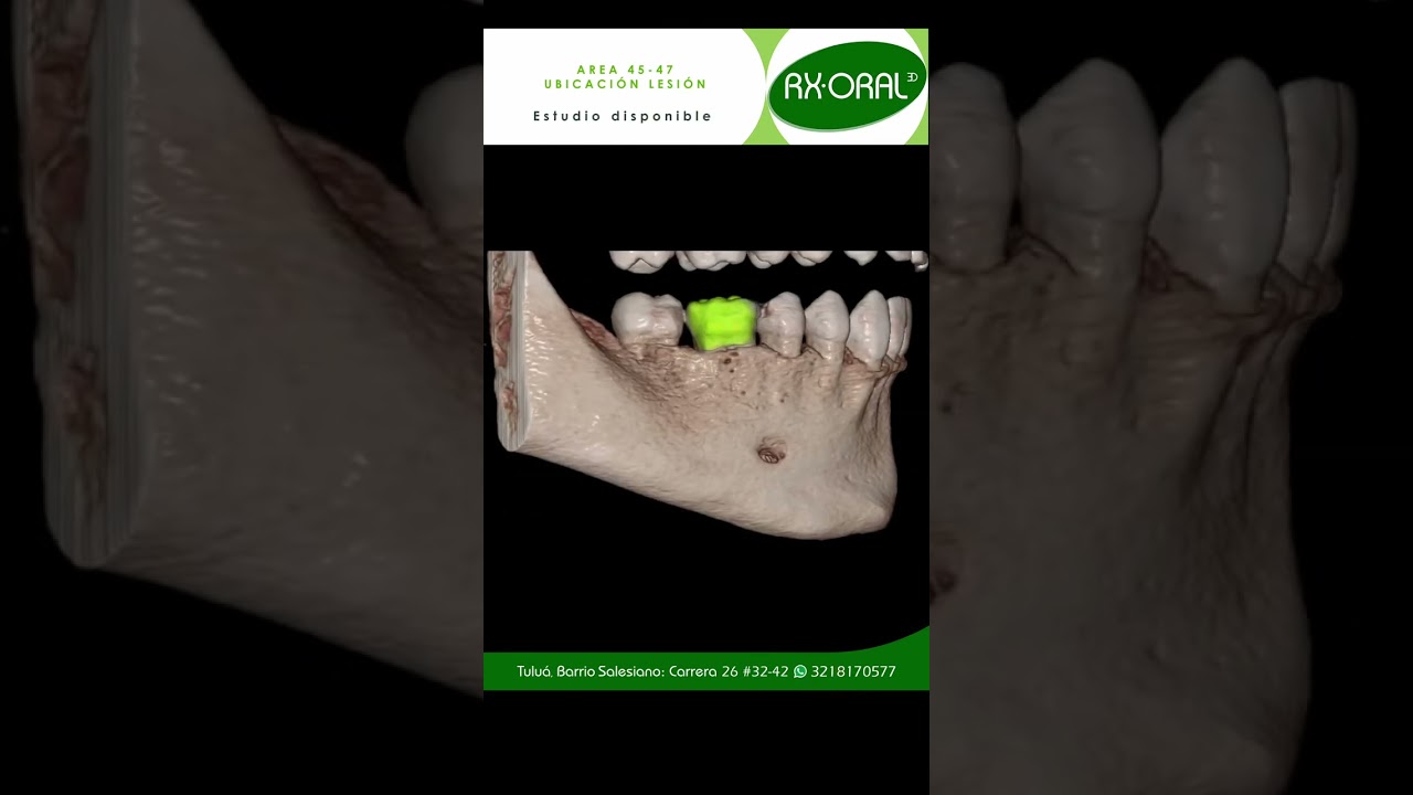 Ubicacion Lesion apical area 45 47 