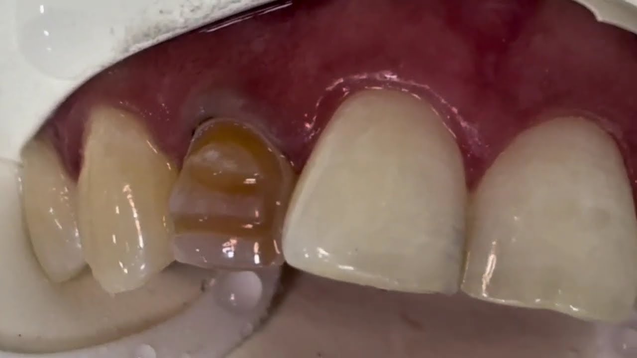 ESCONDENDO DENTE ESCURECIDO COM FACETAS EM RESINA 🦷
