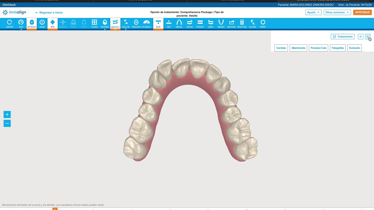 How to solve any severe Rotation with Aligners