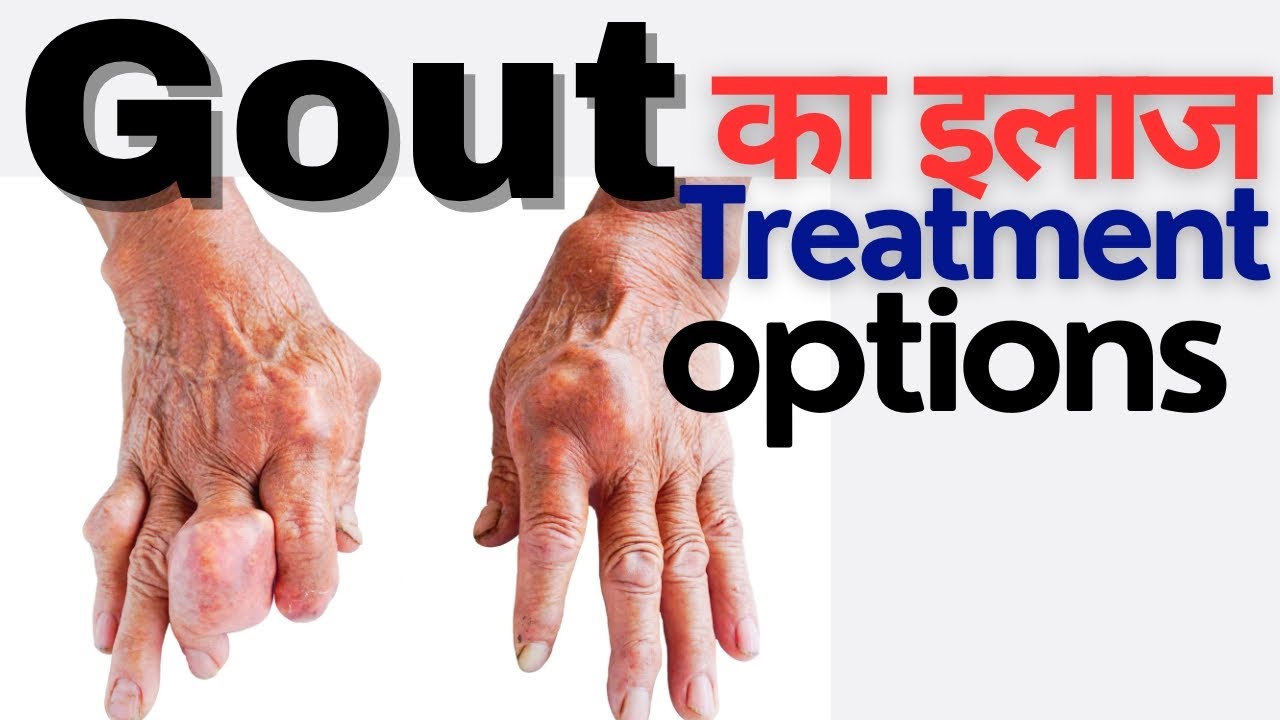 Gout treatment in Hindi | Gout ka ilaj | गठिया का इलाज | best treatment of gout