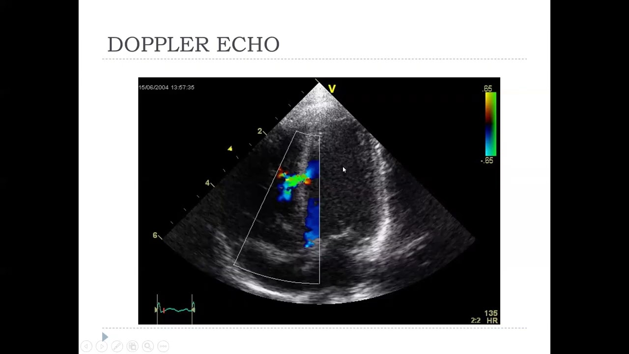Echocardiogram basics workshop, Dr. Mohammad AlAlawan