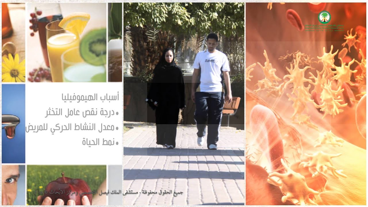 الهيموفيليا - النزاف