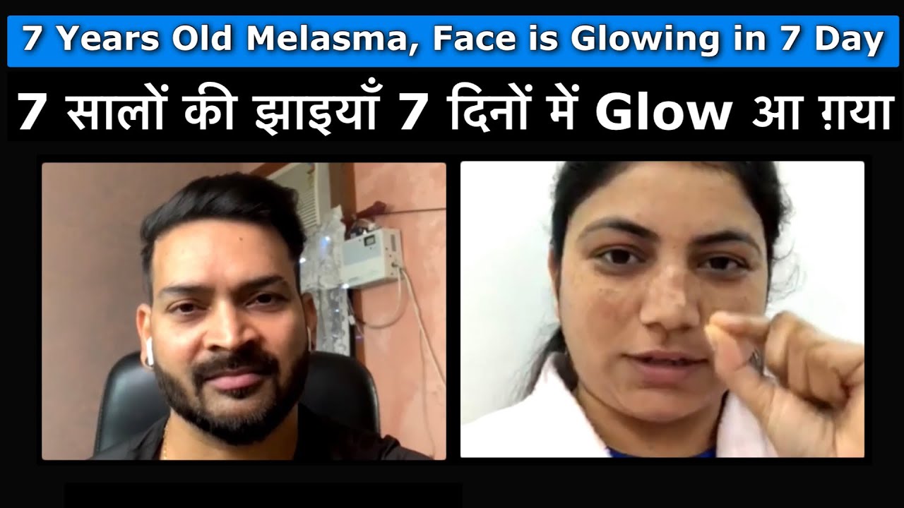 7 सालों की झाइयाँ 7 दिनों में Glow आ ग़या. 7 Years of Melasma, Face is Glowing in 7 days