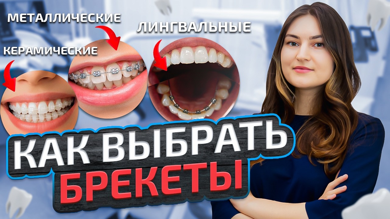 Как выбрать брекеты? Сравнение всех видов от ортодонта