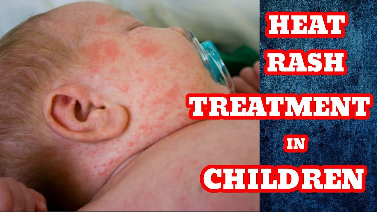 Heat Rash Treatment | How to Get Rid of Heat Rash In Babies, Home Remedies