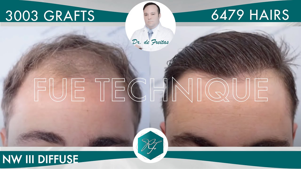 Injerto Capilar Técnica FUE – 3.003 Grafts (6.479 Pelos) – Dr. Rafael de Freitas