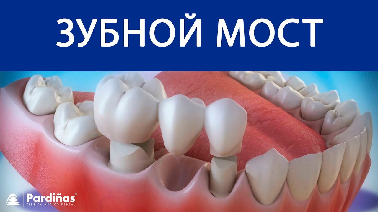 Зубной мост &copy;