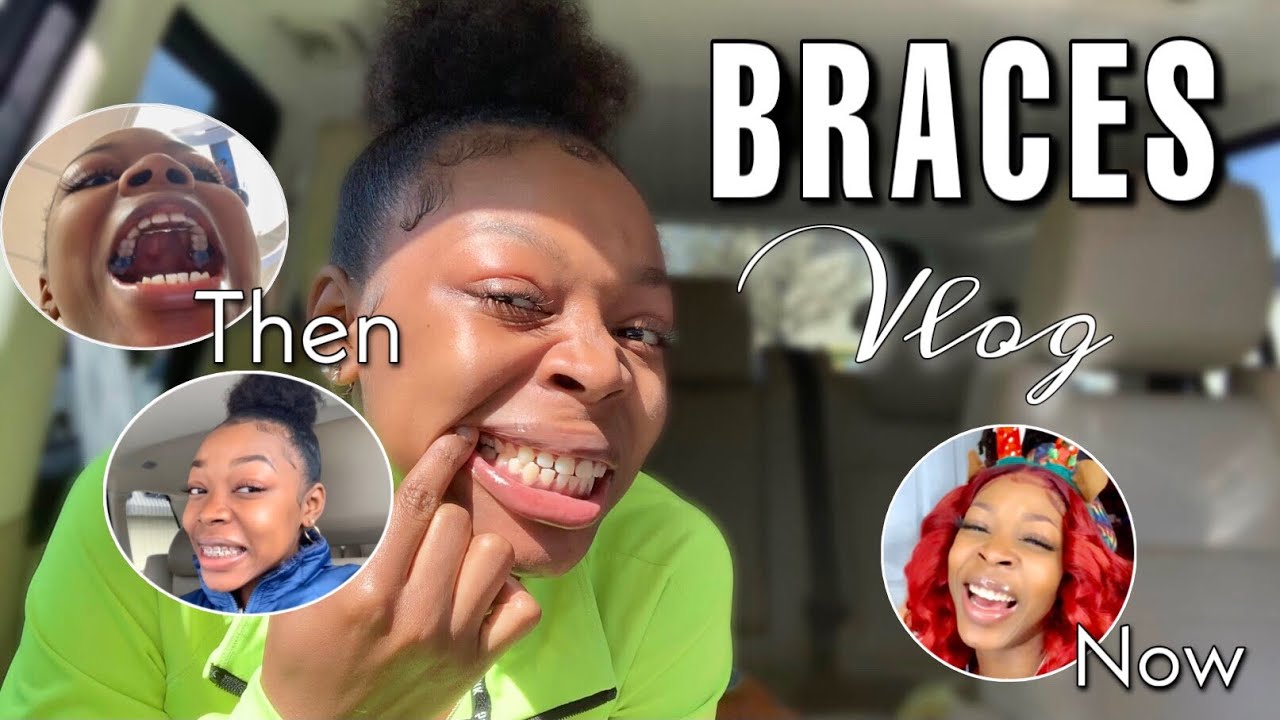 Braces Journey Pt. 1 | Spacers, Tongue crib + removal