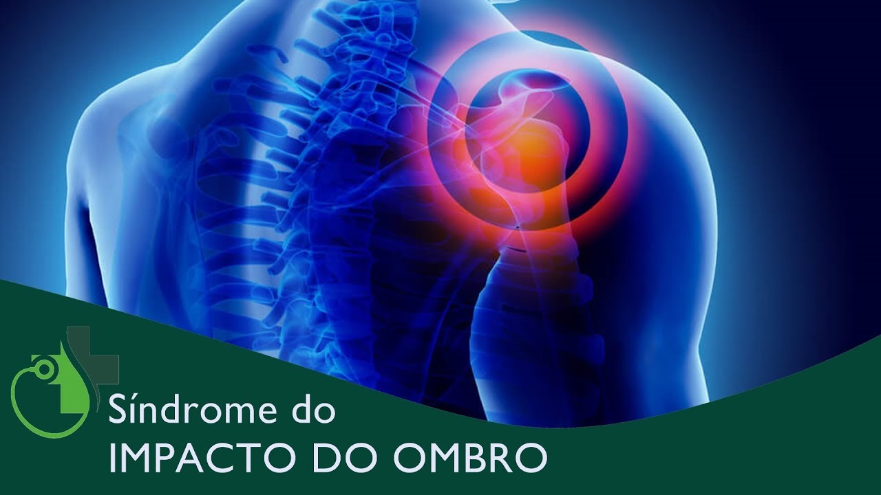 Saiba o que &eacute; a S&Iacute;NDROME DO IMPACTO DO OMBRO