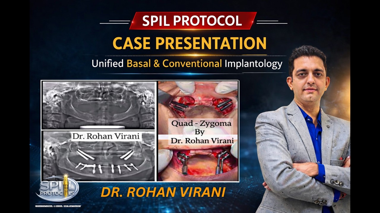 SPIL Protocol Case Presentation | Unified Basal & Conventional Implantology | Dr. Rohan Virani