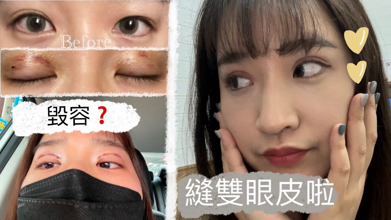 【心得】縫雙眼皮啦！術後三個月心得 —西瓜生活日記