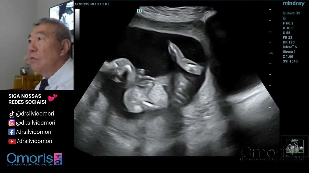 Gestação 17 semanas