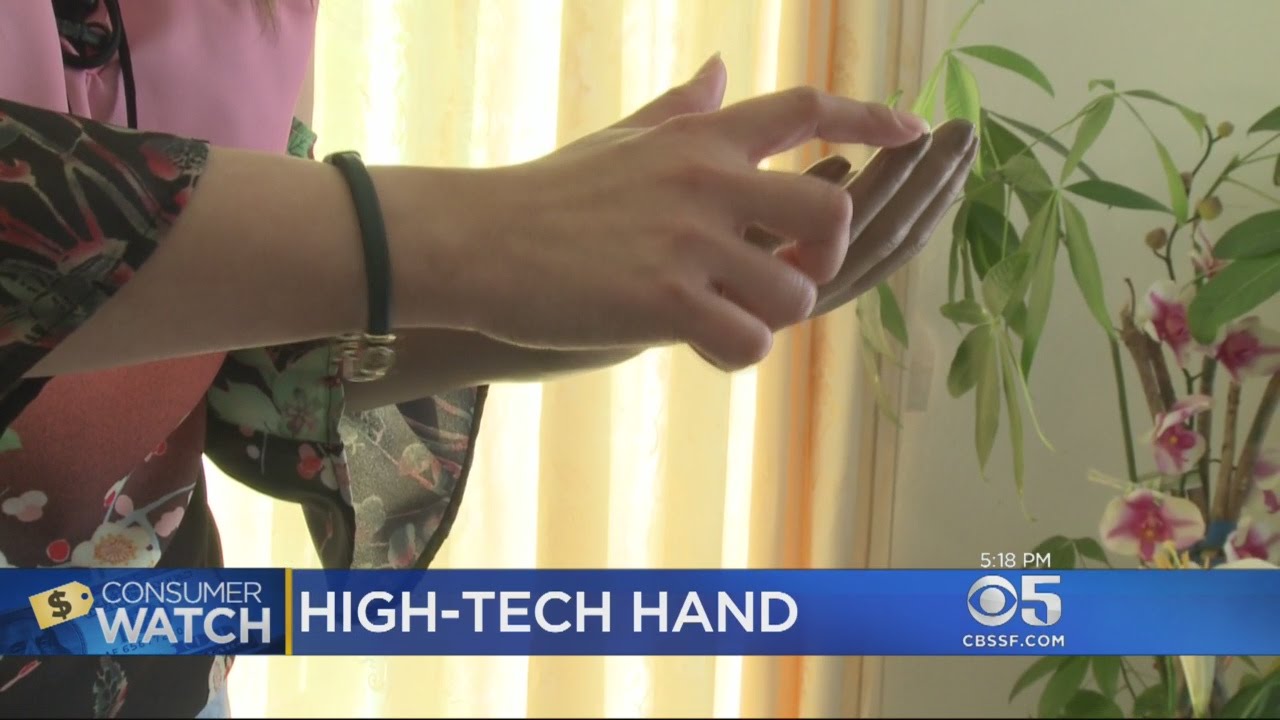 ConsumerWatch Helps Bay Area Woman Get More Modern Prosthetic