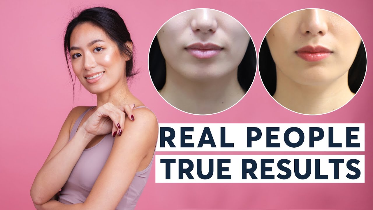 HIFU Skin Tightening | Real People, True Results