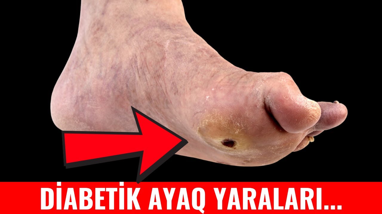 Diabetik ayaq yaralarının yaranmasının səbəbi nədir?