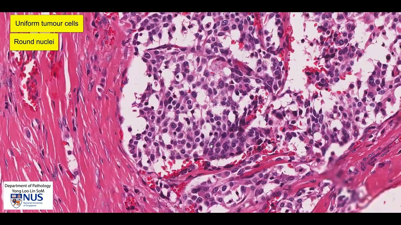 Thyroid medullary carcinoma microscopy - Talking slide