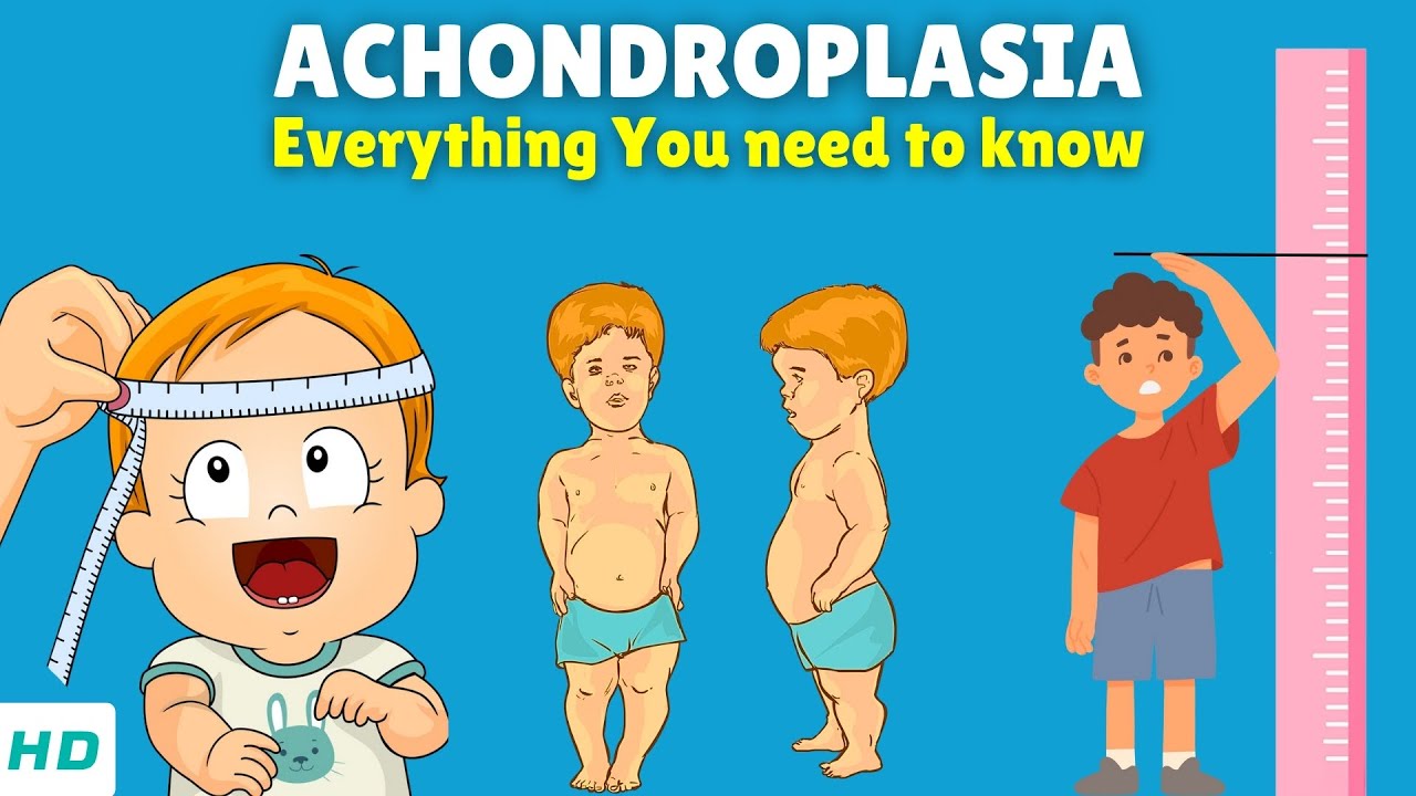 Achondroplasia – Causes, Signs and Symptoms, Diagnosis & Treatment