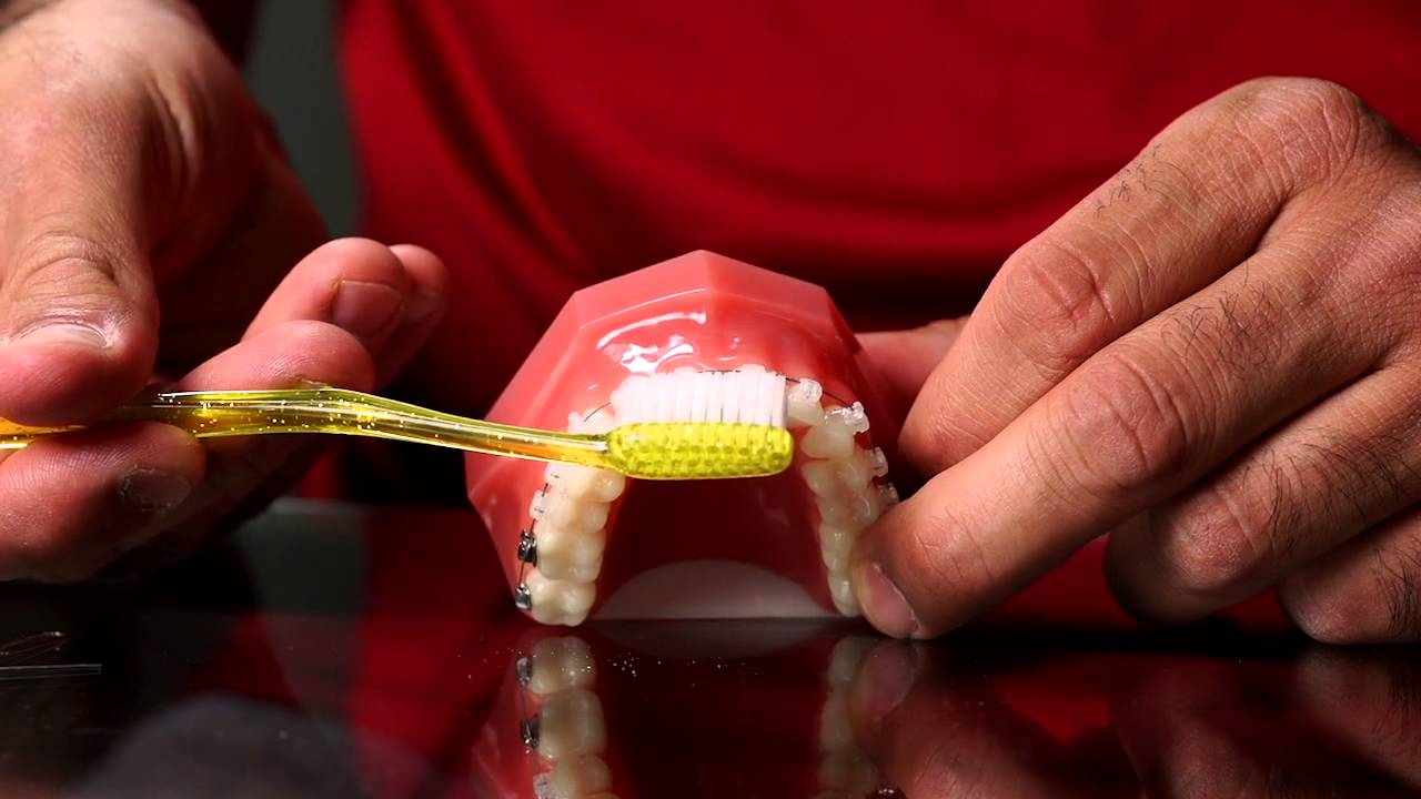 How To Clean Your Teeth While Wearing Braces | Friday Focus
