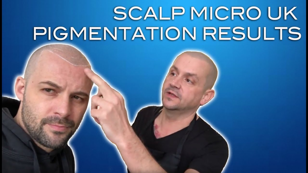 David Hunt - Scalp Micro UK Pigmentation Hair - Craig Bottomley-High