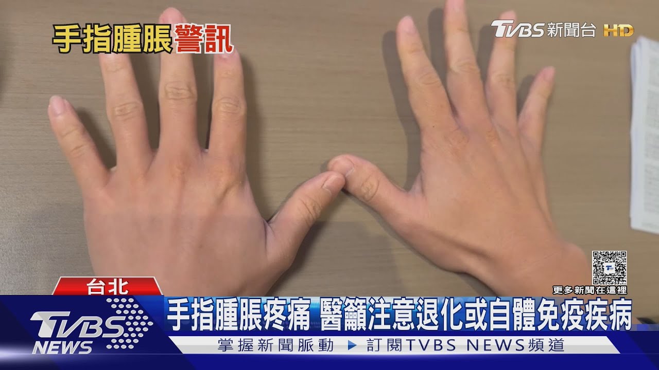 手指出現腫脹疼痛? 當心「這些疾病」引起 醫師:延誤就醫下場慘!｜十點不一樣20250908 @TVBSNEWS01