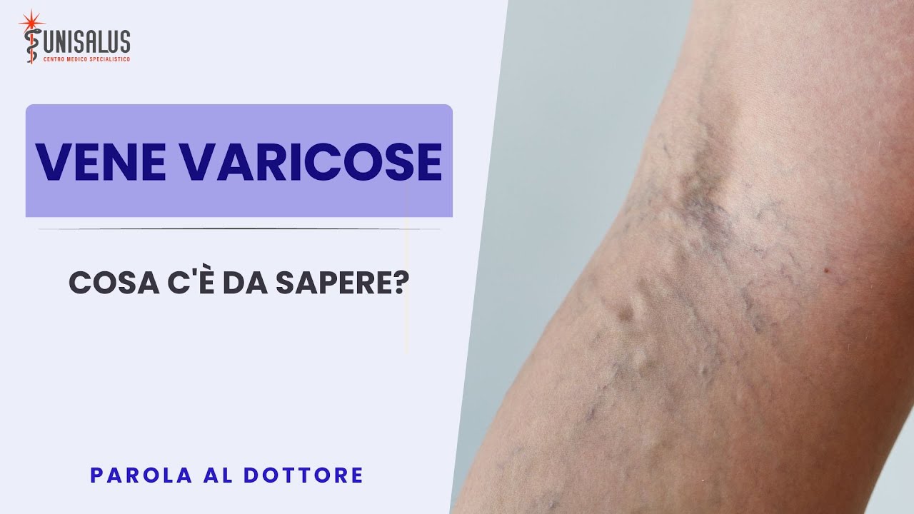 VENE VARICOSE &ndash; che cosa fare? Dott. Daniele Bissacco &ndash; Flebologo