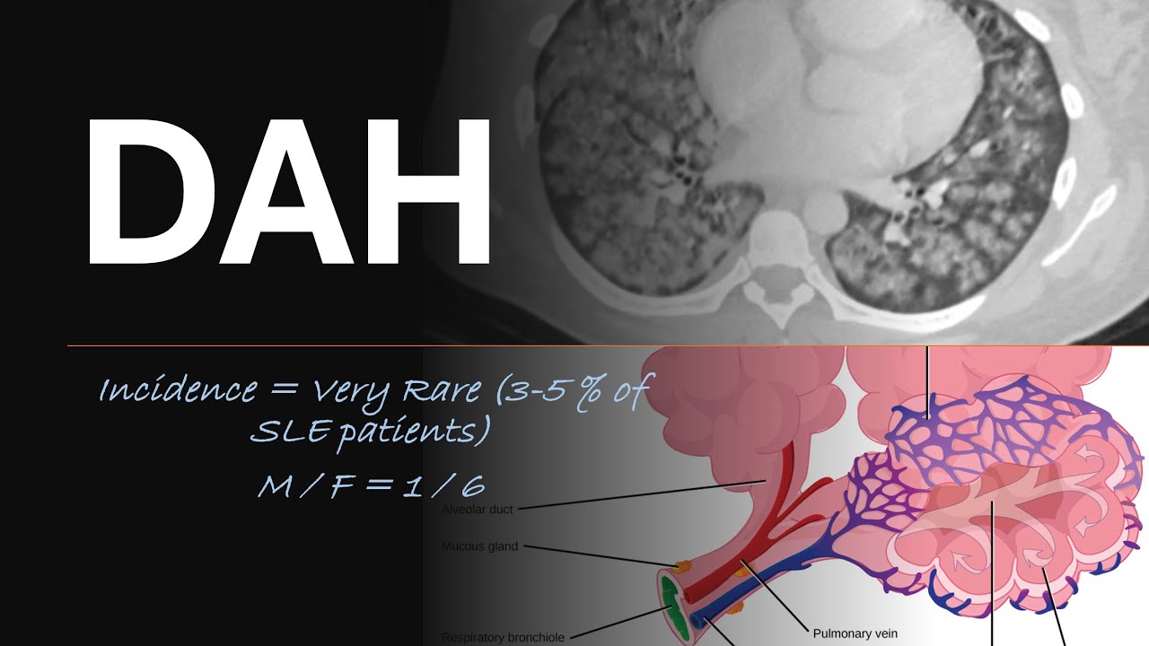 DAH - Understanding DIFFUSE ALVEOLAR HEMORRHAGE  #LungHealth #MedicalEducation #RespiratorySystem