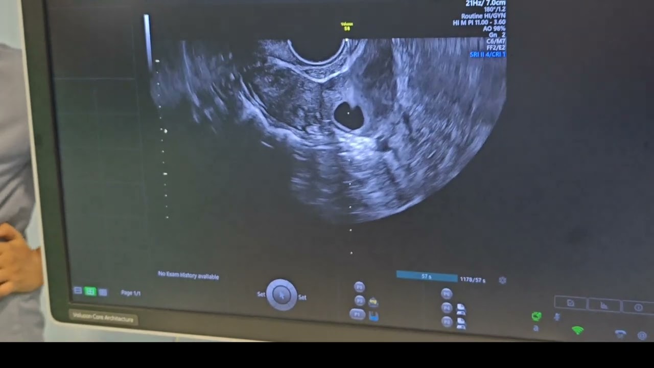 Oocyte pick up ( Egg Retrieval ) unedited in 6 minutes - Dr Shilpa GB
