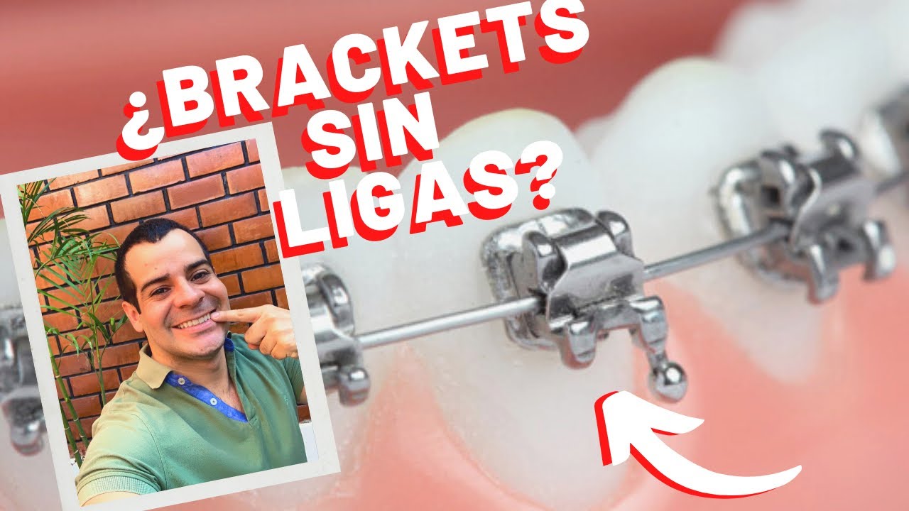 ✨Brackets sin ligas - La mejor opción 💯 | Diego Ubillús
