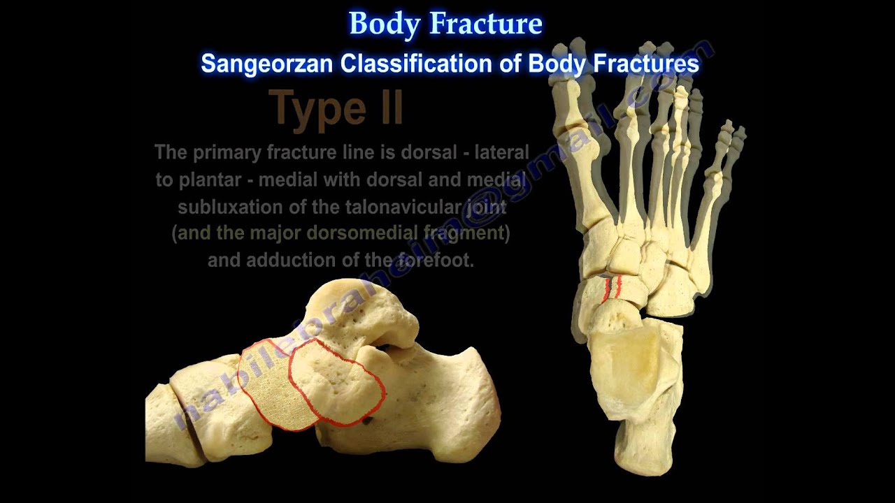 Navicular Fractures - Everything You Need To Know - Dr. Nabil Ebraheim
