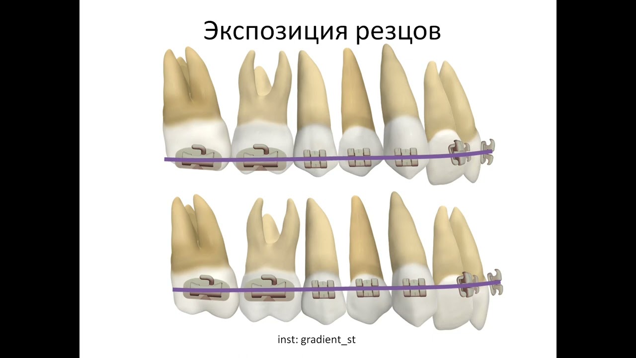 Высота позиционирования брекетов