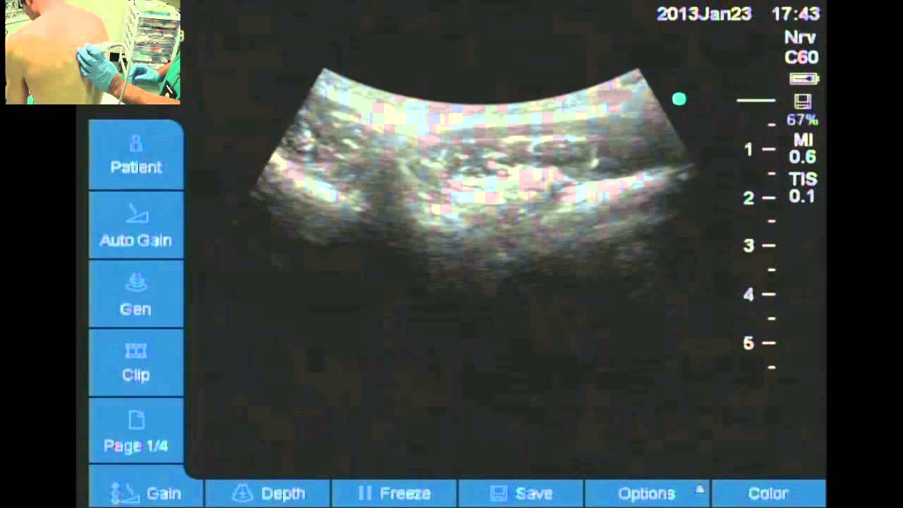 Use of ultrasound to assist thoracic epidural