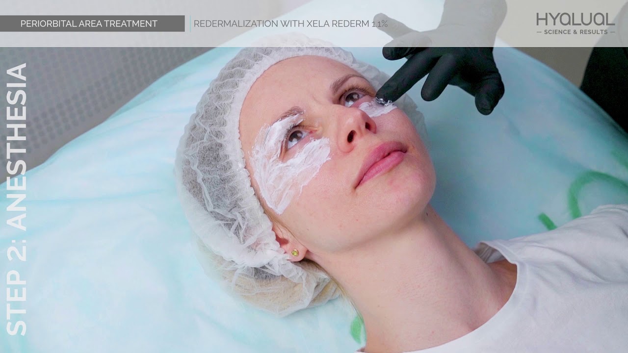 PERIORBITAL AREA TREATMENT. Redermalization with Xela rederm 1,1%