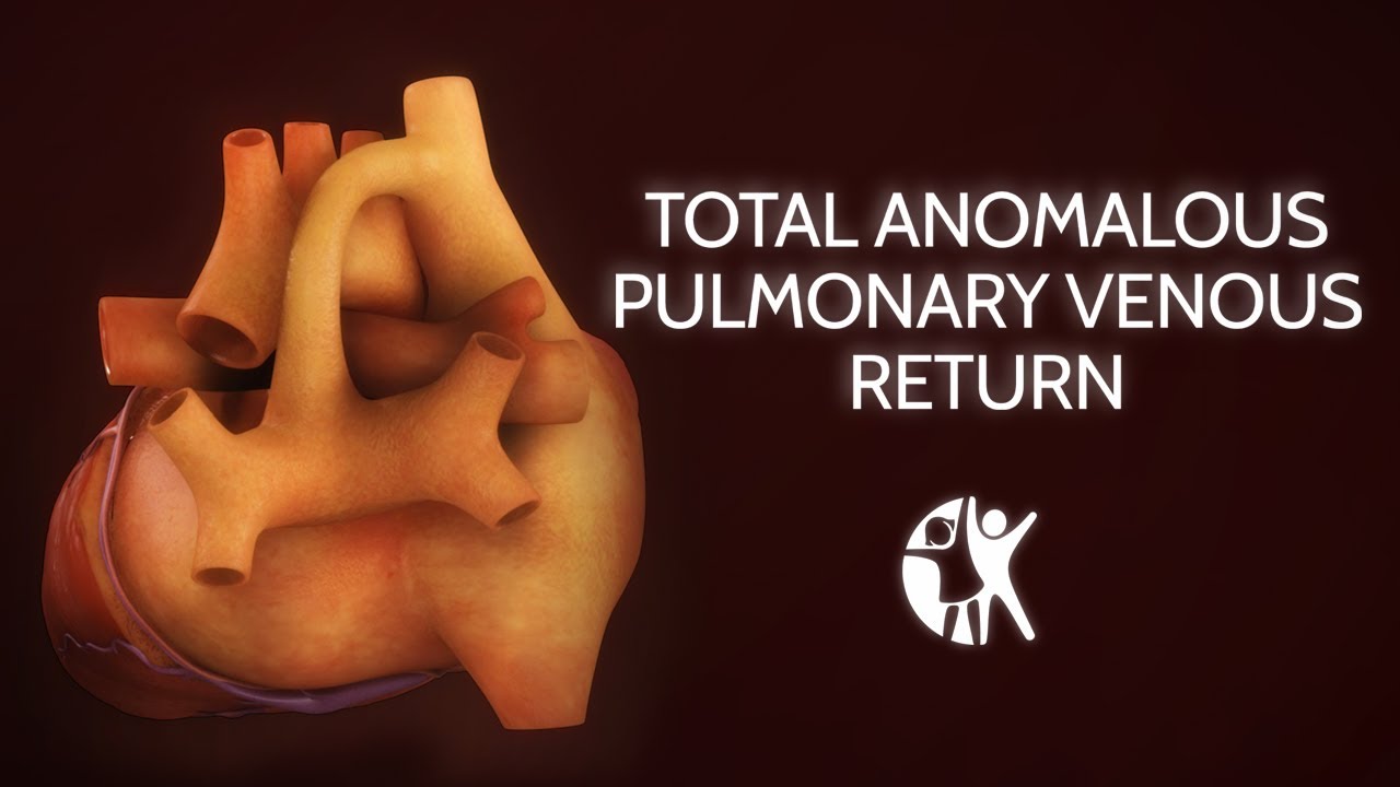 Total Anomalous Pulmonary Venous Return