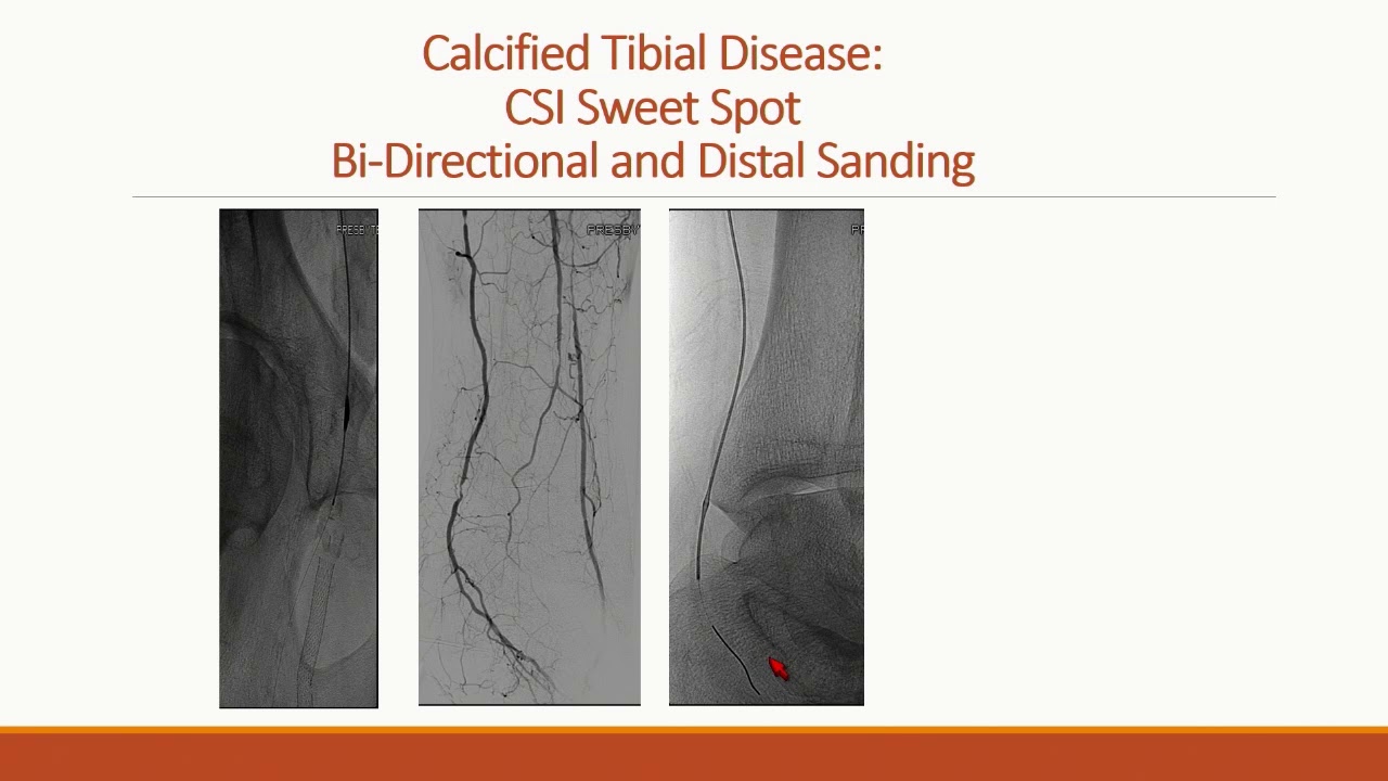 Orbital Atherectomy &ndash; Why, When, and How? - Tony Das, MD