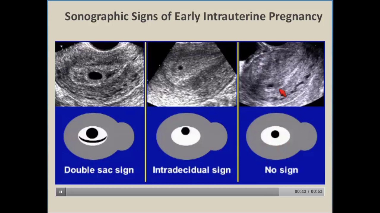 First Trimester Ultrasound non viable fetus