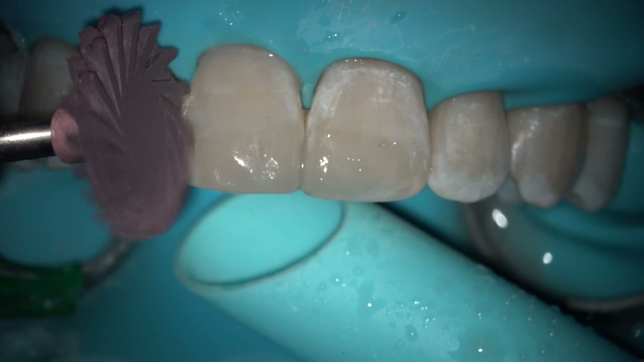 Master TL 04 Kulzer Anterior Case IT